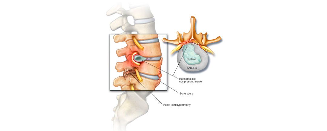 Estenosis del conducto vertebral