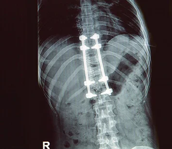 Spine Surgery Guadalajara