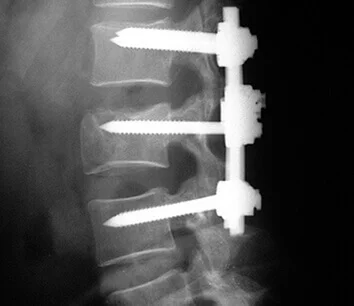 Spine Surgery Guadalajara