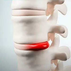 Video - Hernia de Disco - Traumatólogo y Ortopedista